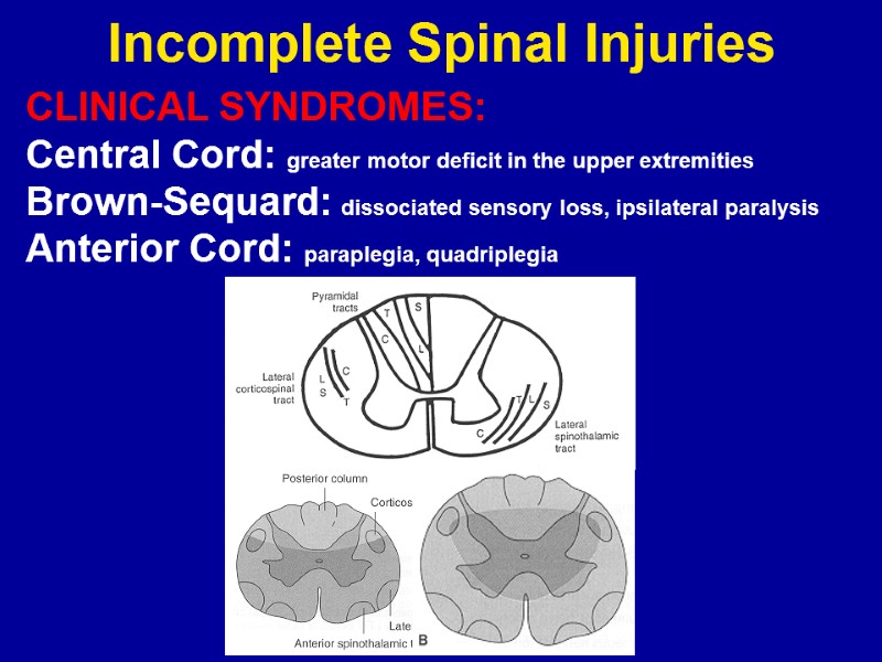 Incomplete Spinal Injuries CLINICAL SYNDROMES: Central Cord: greater motor deficit in the upper extremities